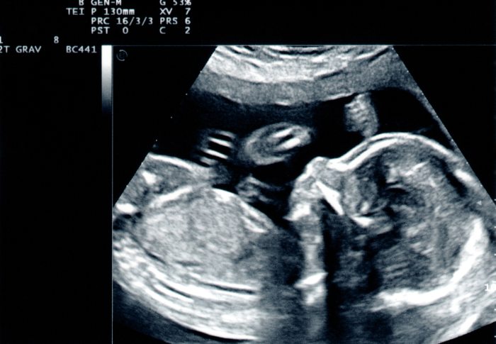 Ovarian Cyst During Pregnancy – What You Need to Know